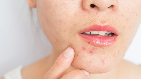 Featured image for “EVERMAT™ – Tratamento para acne”